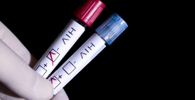 Βρέθηκε η ‘αχίλλειος πτέρνα’ στον ιό HIV του AIDS