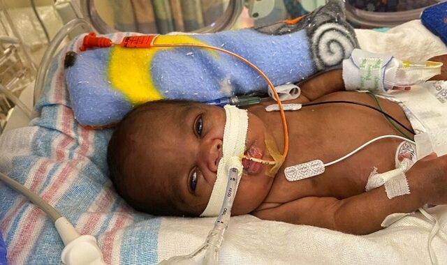 ΗΠΑ: Το πιο πρόωρο μωρό στον κόσμο γεννήθηκε στις 21 εβδομάδες και ζυγίζει 420 γραμμάρια