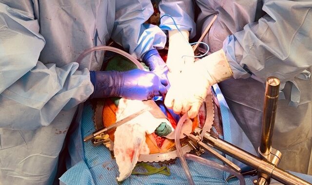 Η πρώτη μεταμόσχευση νεφρών από χοίρο σε άνθρωπο είναι γεγονός