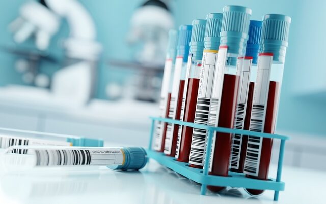 Υπό ανάπτυξη τεστ αίματος που θα προβλέπει ποιος είναι πιθανό να νοσήσει με Long Covid