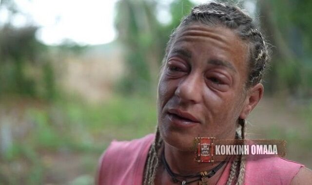 Survivor: Στο νοσοκομείο η Αφροδίτη Σκαφίδα – Παραμορφώθηκε από αλλεργικό σοκ