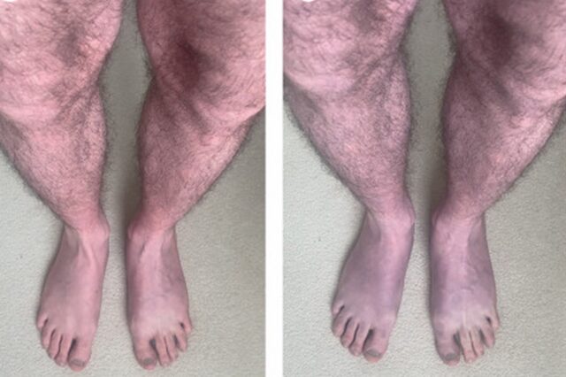 Ένας 33χρονος Βρετανός έβλεπε τα πόδια του να γίνονται μοβ