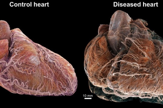 Έτοιμο το Google Earth της ανθρώπινης καρδιάς που εντοπίζει την πρώτη αιτία θανάτου